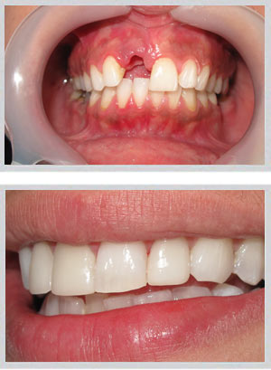 Aesthetic dental implant protocol Beirut cosmetic dentistry