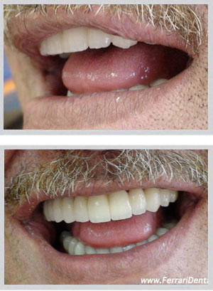 All-on-6 upper jaw All-on-4 lower jaw fixed bridge Beirut