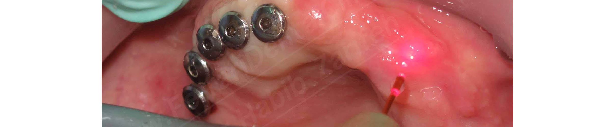 Laser assisted dental implants Beirut Lebanon