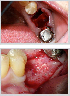 Bone grafting GBR guided bone regeneration Beirut Lebanon