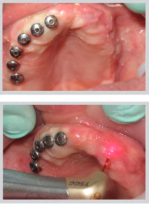 Fixed implant bridge replacing complete denture Beirut Lebanon