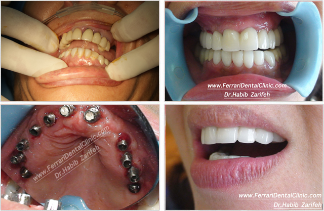 Fixed zirconia bridge on implants Beirut Lebanon