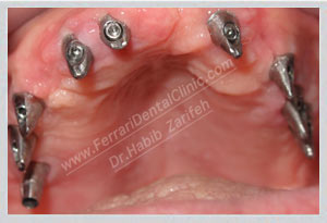Full mouth implants result Beirut Dr Habib Zarifeh