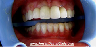 Smile makeover veneers and implants Beirut