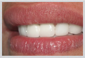 Smile transformation ZEvolution Veneers implant crowns Beirut