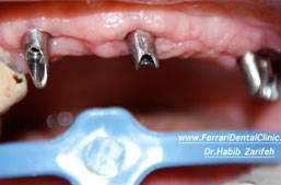Multiple teeth dental implants Beirut