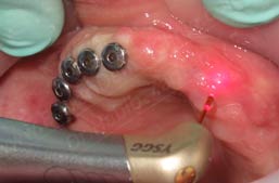 Full mouth dental implants Beirut