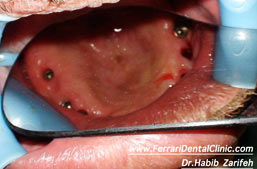 All on 4 All on 6 dental implants Beirut