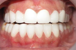 Hollywood smile dental implants Beirut Lebanon