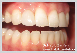 One Day Implant Beirut same day protocol Dr Habib Zarifeh